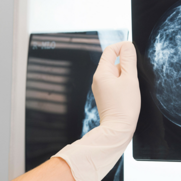 New study aims to deliver better outcomes for triple negative breast cancer patients