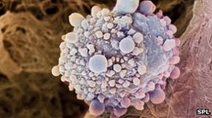 ‘Brake gene’ turned off in pancreatic cancer