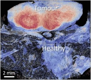 Breast cancer image courtesy of Harry Perkins