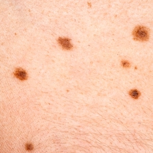 Some moles become skin cancer