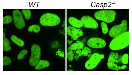 Abnormal cells courtesy of Centre for Cancer Biology