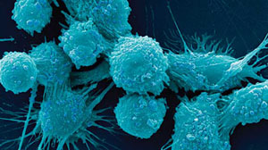 Ovarian Cancer Awareness month kicks off with significant discovery