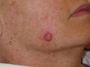 Skin cancer on a mole