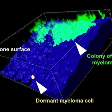 Researchers reveal key to targeting dormant cancer cells