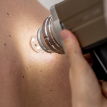 Melanoma risk in young Australians goes beyond the burn