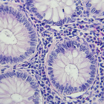 Five-year data supports liquid biopsies to guide colon cancer treatment